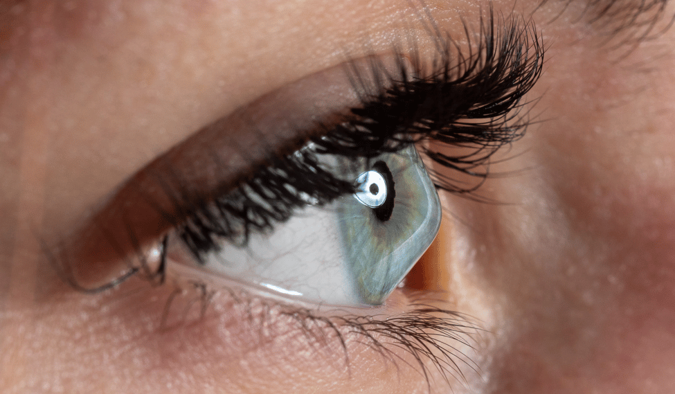 Up close of an eye with keratoconus