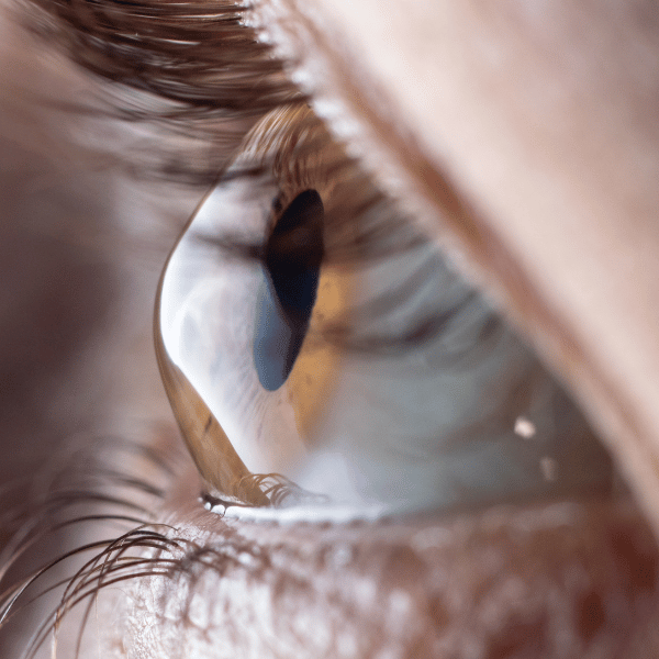 Close up image of an eye with keratoconus