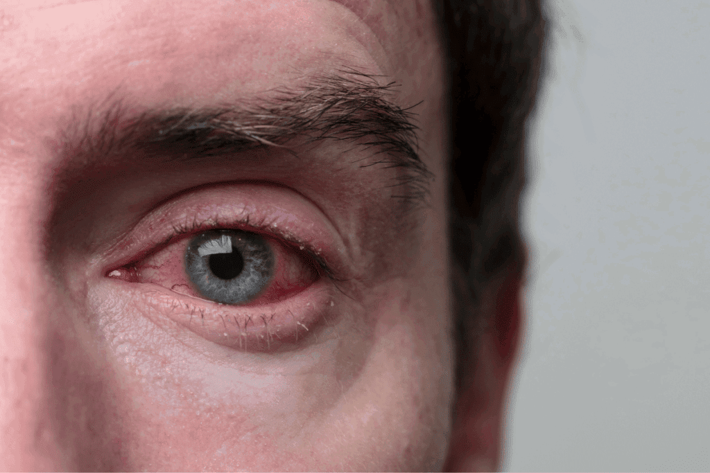 Close up of a man's eye with pink eye