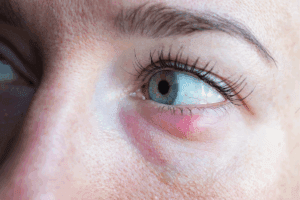 Close up of a woman's eye that has a stye