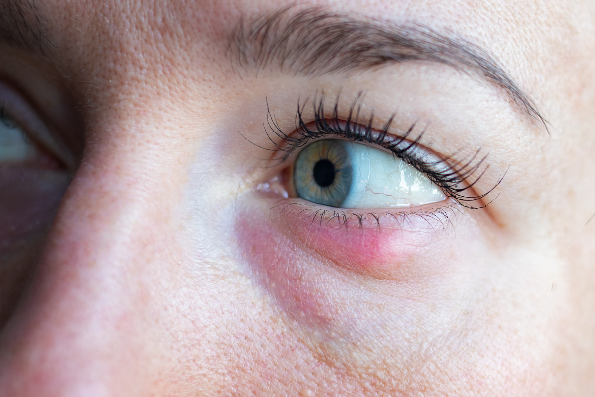 Home Remedies for an Eye Stye - Emerald Point Eye Care